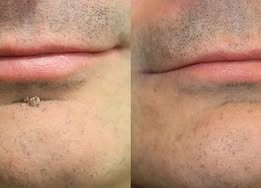 ShapeOil®2-in-1 Microneedle & Hydrocolloid Patch