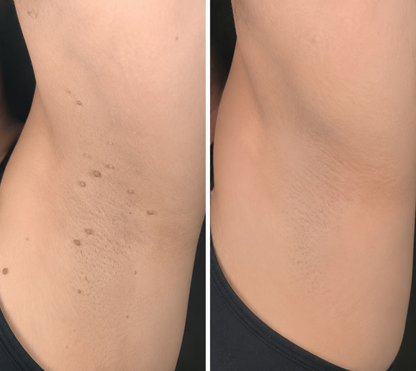 ShapeOil®2-in-1 Microneedle & Hydrocolloid Patch