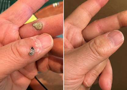 ShapeOil®2-in-1 Microneedle & Hydrocolloid Patch